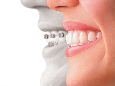 A split-screen image featuring a smiling woman on the left and a dental implant on the right, with both images overlaid to emphasize the transformation.