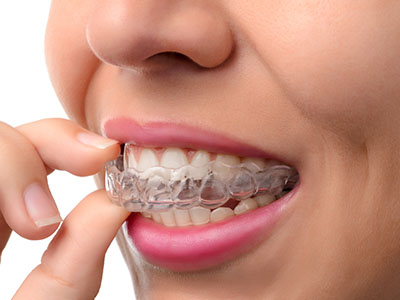 The image shows a person, likely a woman based on the visible facial features, with her finger in her mouth. She is wearing a clear orthodontic appliance, commonly known as braces, and appears to be examining or adjusting them.
