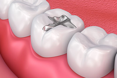 The image shows a close-up of a dental implant within the tooth structure, with the focus on the implant itself.