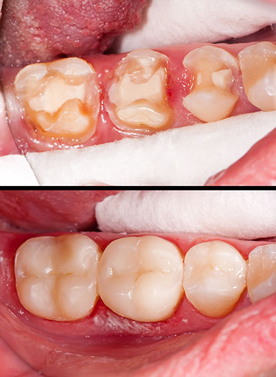 The image shows a close-up of a person s mouth with teeth that appear to be in poor condition, likely due to decay or gum disease. There is visible discoloration and damage to the teeth, as well as some missing teeth. The mouth is open, revealing the inner surfaces of the teeth and the tongue. The upper portion of the image has a smaller photo within it, showing the same mouth with a similar condition but from a different angle.