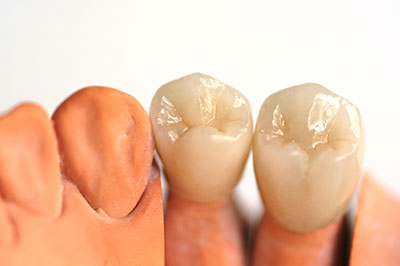 The image shows a set of dental implants, likely for a lower jaw, with tooth-like crowns attached to the implants, displayed against a white background.