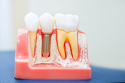 A close-up of a dental model with teeth and root canals, showcasing the tooth implantation process.