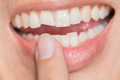 The image shows a close-up of a person s mouth with teeth, and the person is holding a finger near their lips.