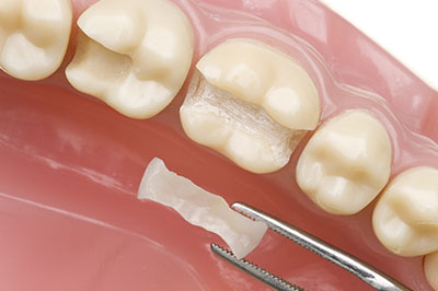 Dental implant preparation with a drill and dental material in a mouth model.