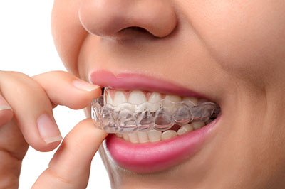 An adult female with a wide smile, wearing clear aligners for teeth straightening.