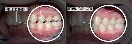 The image shows a side-by-side comparison of a human mouth with teeth and gums, before and after dental implants or prosthetics.