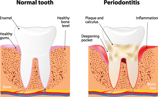 The image is a medical illustration showing the progression of tooth decay from normal to severe stages, with labels indicating the different stages and their corresponding symptoms.