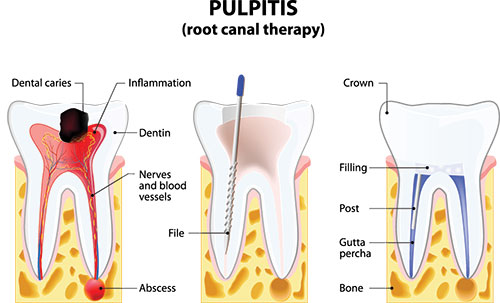 The image is an educational illustration of the human mouth with a focus on dental health, specifically showing the structure of teeth and gums, and highlighting the process of root canal therapy.