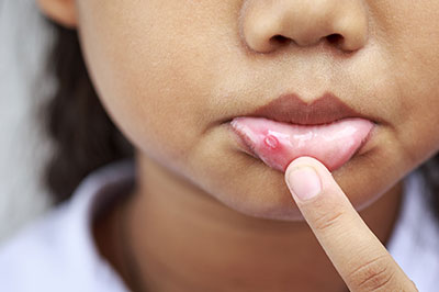 The image shows a child with a small red bump on the lower lip, holding their finger near the affected area.