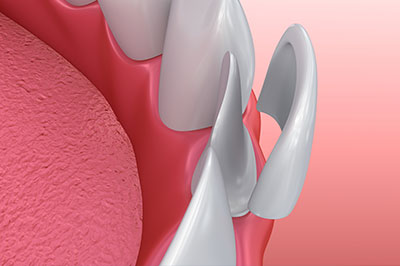 The image shows a close-up view of a human mouth with an upper denture, featuring multiple teeth and a partial denture on the right side.