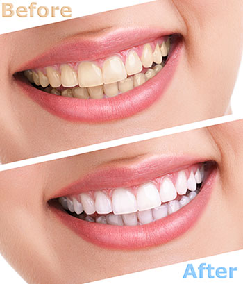 The image shows a three-step transformation of a person s teeth, with the first step showing yellowish stained teeth, the second step showing cleaner teeth, and the third step showing a radiant white smile after dental treatment.