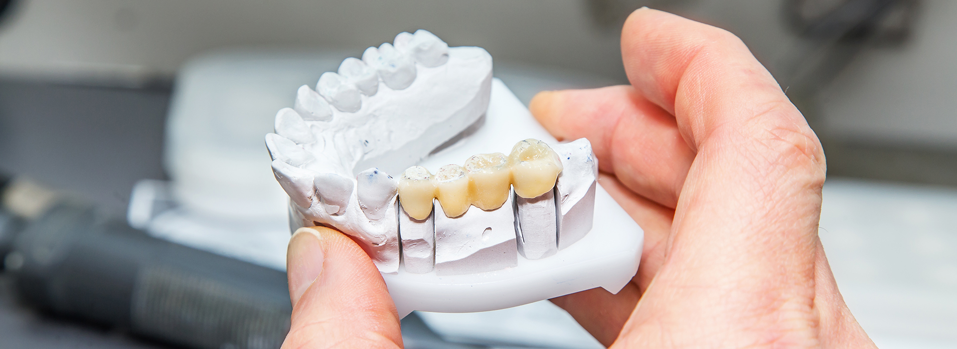 A person is holding a white dental model with visible teeth and gums.