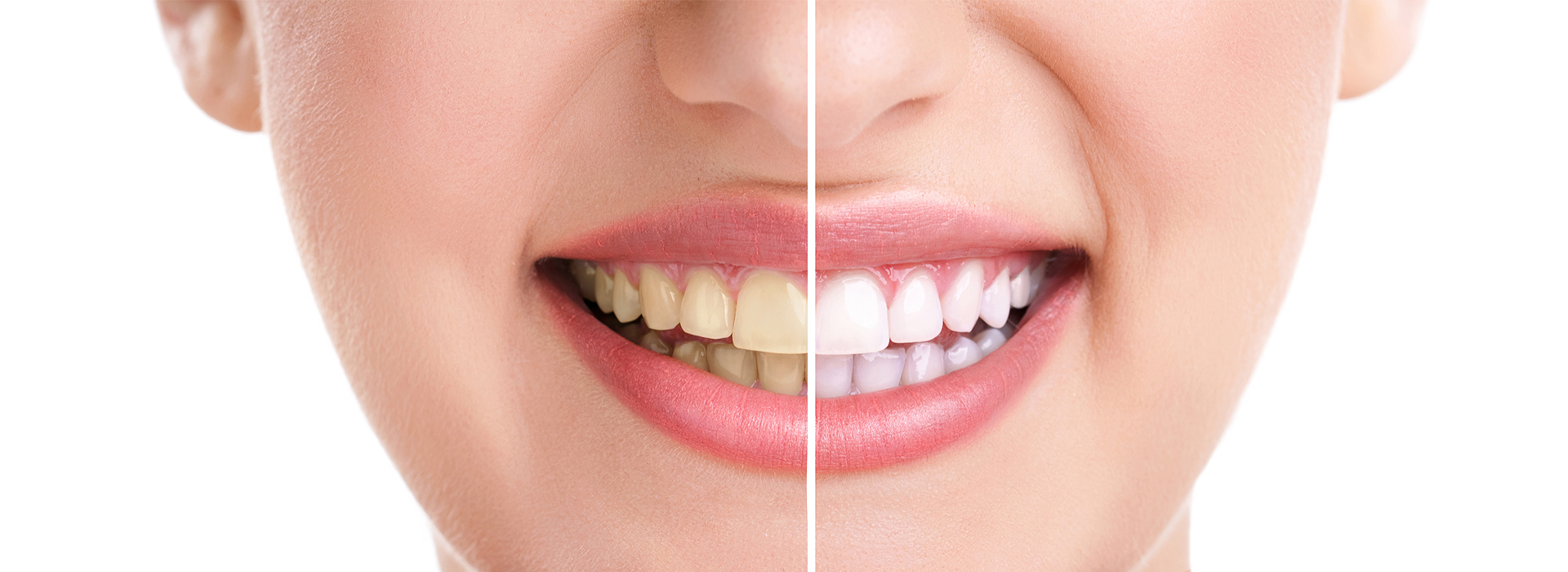 The image is a split-screen comparison of a person s face before and after teeth whitening treatment, highlighting the improvement in their smile.