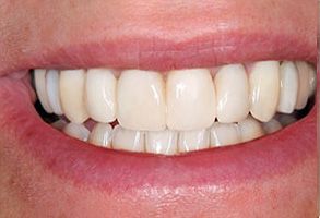 The image shows a close-up of a person s smile with white teeth, and the individual appears to be middle-aged or older.
