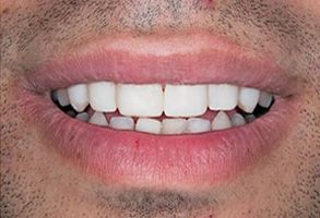 Alt  tag   A close-up image of a person s smiling face with teeth, showcasing a bright smile.