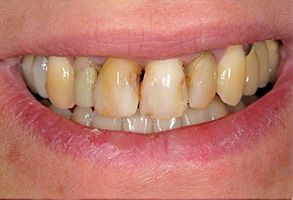 Image of a person s mouth with yellowed teeth and gums, showcasing dental decay.