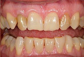 The image shows a close-up of a person s teeth with a focus on their yellowish hue, likely indicating poor oral hygiene or dental issues.
