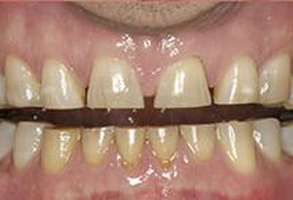 The image shows a close-up of a person s teeth, with a focus on an area where the teeth are discolored and stained.